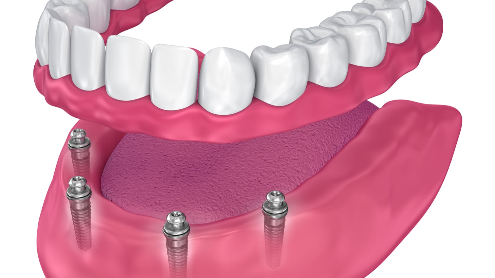 Rendering of an all-on-four denture being set in place