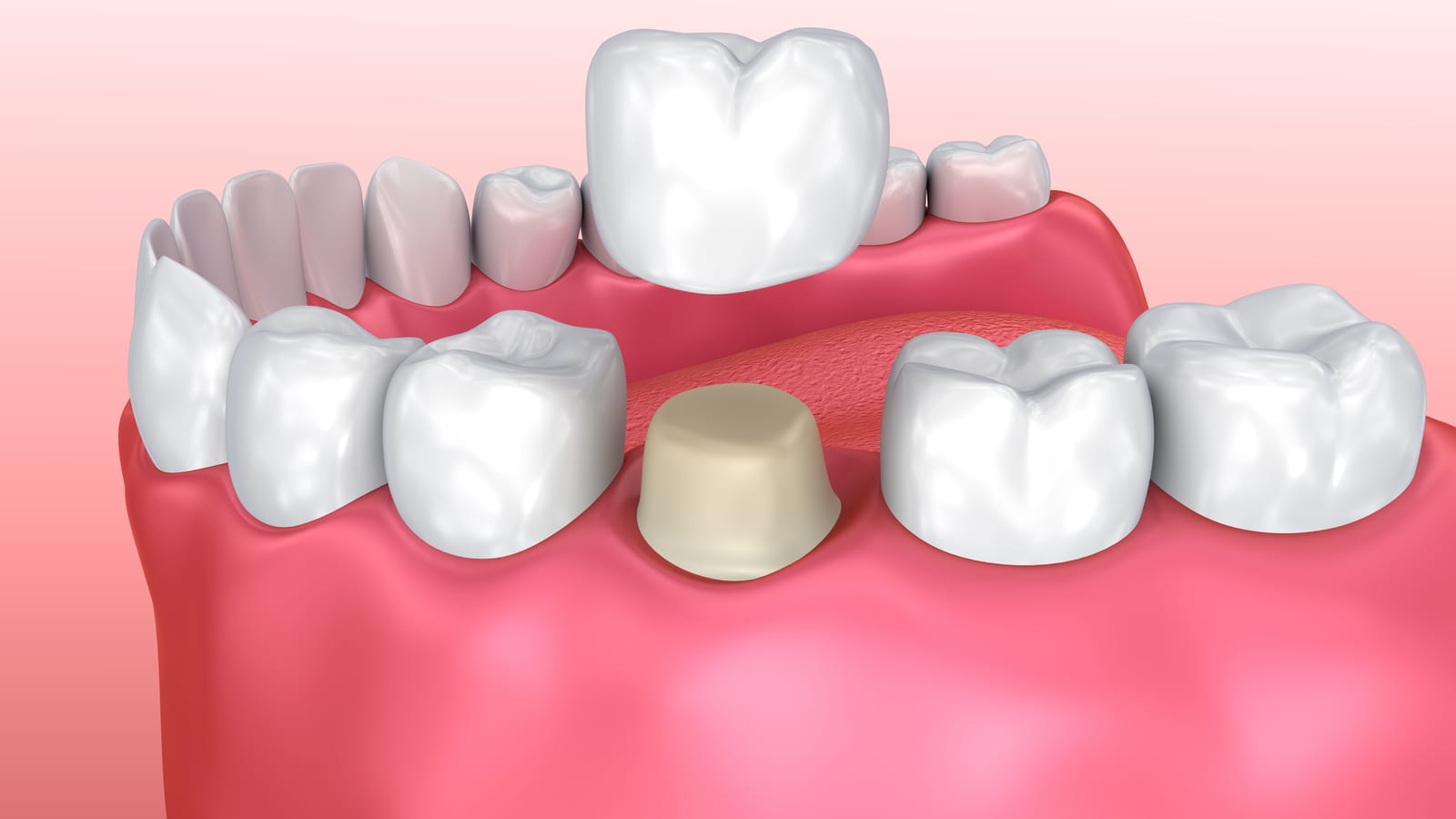 Rendering of a dental crown placement